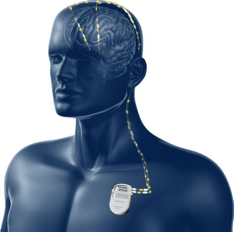 neurostimulator implant for parkinson's